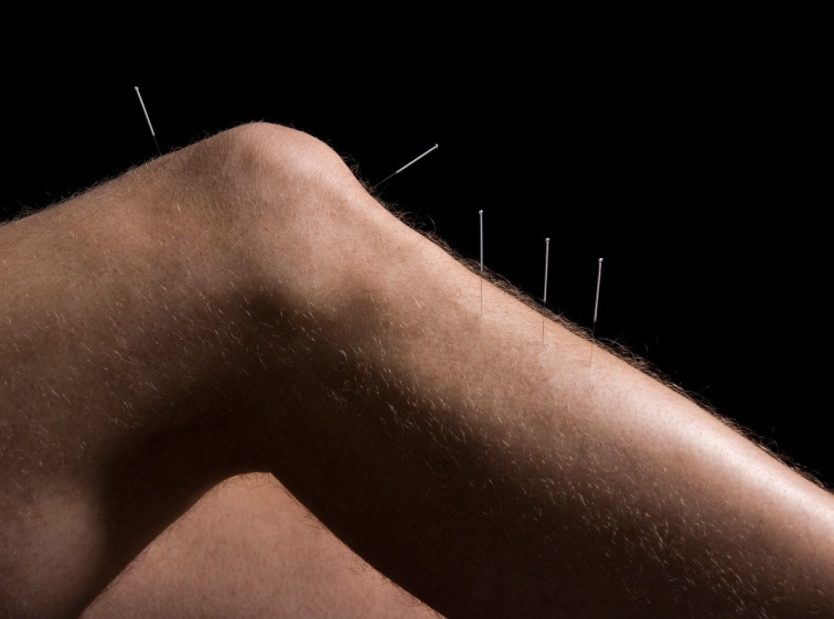 acupuncture-knee.jpg