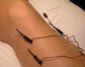 electro-acupuncture.jpg